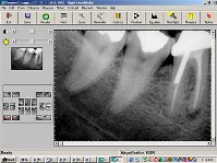 Digital Xrays